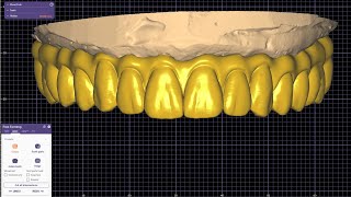 dental full arch exocad galway with gingiva as pontics Mr Walid Mansour 00201005587414 Egypt [upl. by Westberg]