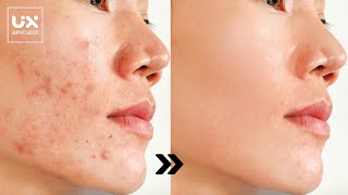 Skin smoothing adjusts and removes skin imperfections and acne from portraits in Photoshop [upl. by Nileak752]