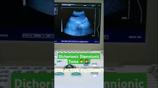 Dichorionic Diamnionic twins pregnancy 🥰🥰😍😍shortyoutubevideo plzzsubscribe babyultrasound [upl. by Anihtyc]