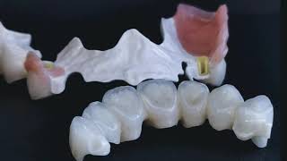 BioHPPPeek Removable Partial Denture  Zirconia frame  Emax Ceram Layering BioHPP PEEK RPD [upl. by Attekal]