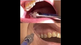 Dental Anesthesia Infiltration Techniques for Maxilla Inferior Alveolar Nerve Block for Mandible [upl. by Bradway]