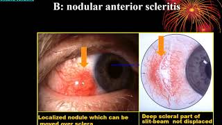 Sclera Lect By Dr Abdul Basir Safi 1 [upl. by Kreiker]