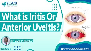 Iritis  Anterior Uveitis  Shekar Eye Hospital [upl. by Anaik262]