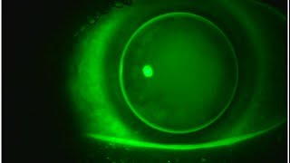 Multifocal GP Contact Lenses Video 3 [upl. by Hadsall]