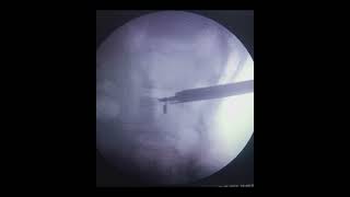 L1L2 Discitis treated with Spine Endoscopy [upl. by Euqinobe]