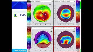 Quick guide to reading corneal tomography Part 6 [upl. by Milore]