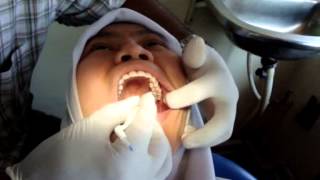 Lingual Bonding by Dr Dhiraj Shetty Locus Lingual Orthodontics [upl. by Hazelton]