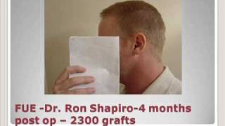 FUE hair transplant patient slide show 2300 grafts Dr Ron Shapiro [upl. by Elissa]