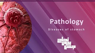 Diseases of stomach Pathology L3 Part 2 [upl. by Akemehc]