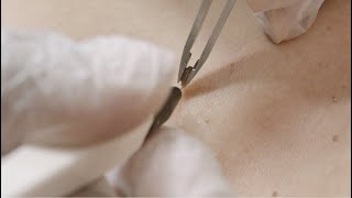 Skin tag Removal using Electrolysis by Sterrex [upl. by Treblih]