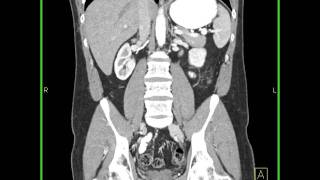 Abdomen Small BowelCrohns 3D mapping shows thickening of the ileum with increased vascularity [upl. by Atnoid]