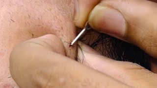 ASMR beard care ingrown hairs and removing pimple Hair ASMR Autonomous Sensory Meridian Response [upl. by Enailil]