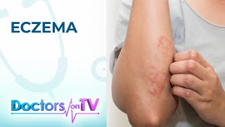 Eczema Symptoms Causes and Treatment  Doctors on TV [upl. by Forland]