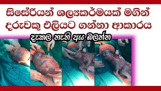 සිසේරියන් සැත්කමකින් දරුවකු එලියට ගන්නෙ මෙහෙමයි jeewana gamana [upl. by Schulze]