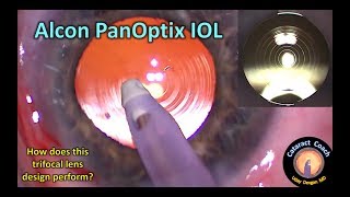 is the Alcon PanOptix trifocal IOL the best choice for cataract surgery [upl. by Ecadnarb249]