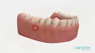 Ulcer  Lapointe dental centres [upl. by Anyahs437]