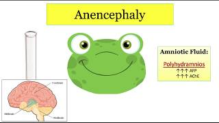 12DaysinMarch Congenital Neuro Abnormalities Part 1 for the USMLE Step One Exam [upl. by Hesler548]