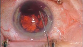 Safe and Simple Hyphema Removal [upl. by Dart]