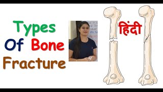 Types of Fracture in Hindi  Bones Fracture  RajNEET Medical Education [upl. by Nnayt727]