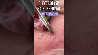 Electrolysis Hair Removal [upl. by Haimorej]