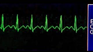 Sinus Tachycardia  Taquicardia Sinusal [upl. by Alliber614]