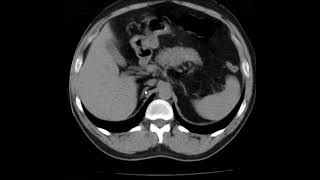 Agenesia renal unilateral [upl. by Severen]