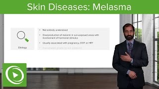 Skin Diseases Melasma Chloasma – Pathology  Lecturio [upl. by Ceil418]