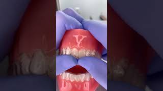 Invisalign tips [upl. by Dolloff851]