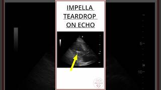 IMPELLA TEARDROP ON ECHOCARDIOGRAM A METALLIC CONE 7mm impellla [upl. by Donald289]