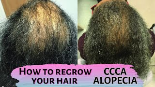 How to regrow your hair  CCCA Alopecia Central Centrifugal Cicatricial Alopecia hair care [upl. by Taran]