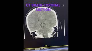 Ct brain coronal section ctbrain science medicalimaging trauma [upl. by Axela]