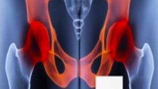 Chronic Pelvic Pain  Usapang Pangkalusuga [upl. by Ara]