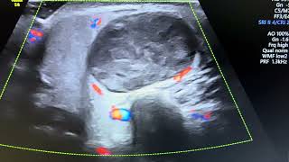 Ultrasound of pathologically confirmed case of pleomorphic adenoma of parotid gland [upl. by Esinel340]