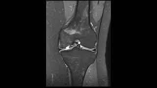 Osteochondritis dissecans [upl. by Yelehsa]