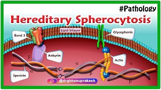 Hereditary Spherocytosis Animation  Etiology Pathology Clinical features Diagnosis and Treatment [upl. by Maxima]