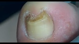 Satisfying toenail repair [upl. by Porett]