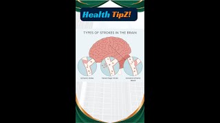 Types of stroke in brain sroke brainstroke [upl. by Yehs243]