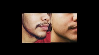 Minoxidil Beard 2 Months Transformation No Genetic [upl. by Chilcote]