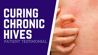 Can Chronic Hives Be Cured  Chronic Hives Patient Testimonial [upl. by Leinehtan]