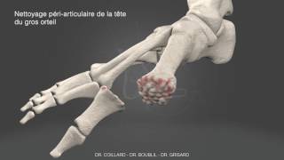 Dr Coillard  Dr Boublil  Dr Grisard  Arthrolyse du gros orteil [upl. by Carrick]