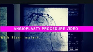 How heart stent inserted  Angioplasty Procedure video of heart  Stent Placement in Heart [upl. by Eanrahs115]