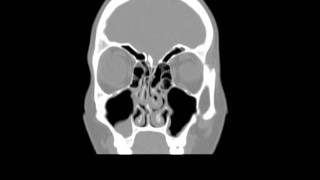 Coronal CT Scan of a right antrochoanal polyp [upl. by Yhtac]