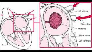 Left atrial myxoma [upl. by Metcalf]