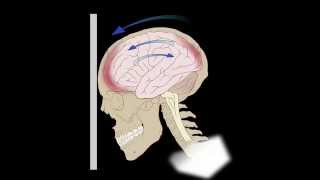 Common Brain Injuries Coupcontracoup [upl. by Ryley786]