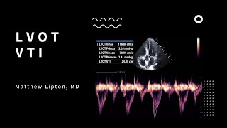 How to use the LVOT VTI to determine fluid responsiveness for the critically ill patient [upl. by Odirfliw]