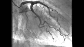 Kardiologie linkes Herzkranzgefäß  Darstellung der Kornararterien [upl. by Iblehs]