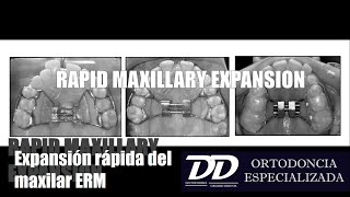 EXPANSION RAPIDA DEL MAXILAR [upl. by Brader]