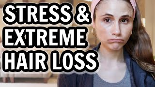 Tips for EXTREME HAIR LOSS from STRESS Dr Dray [upl. by Yand]