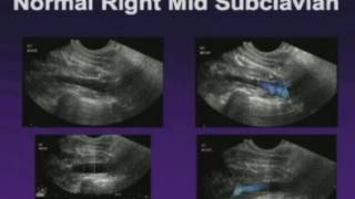 Upper Extremity Venous Exam Technique and Interpretation [upl. by Sacksen541]