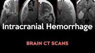 Intracranial Hemorrhage Brain CT scans of different conditions [upl. by Leirbaj]